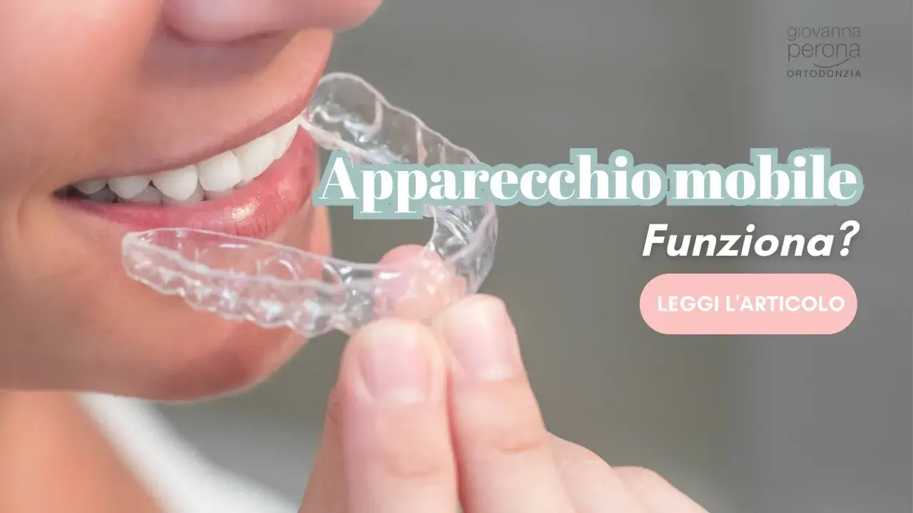 Dente allineato con un apparecchio mobile trasparente. Scopri se funziona davvero.