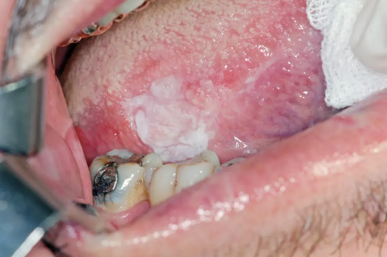 Lesione bianca sulla lingua, in attesa di biopsia escissionale.
