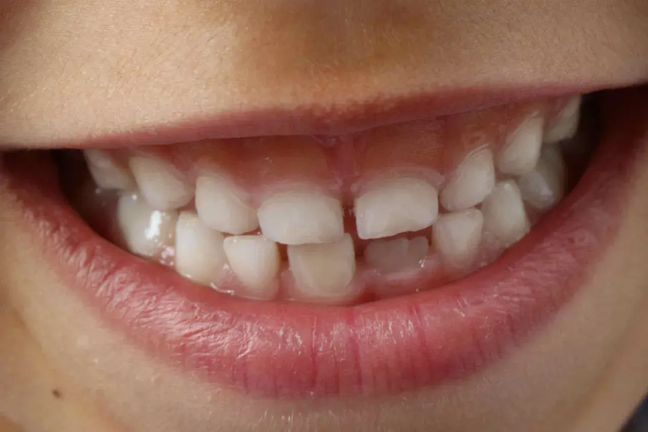 Denti con opacità e striature biancastre, segni di ipomineralizzazione denti, che rendono lo smalto più fragile.