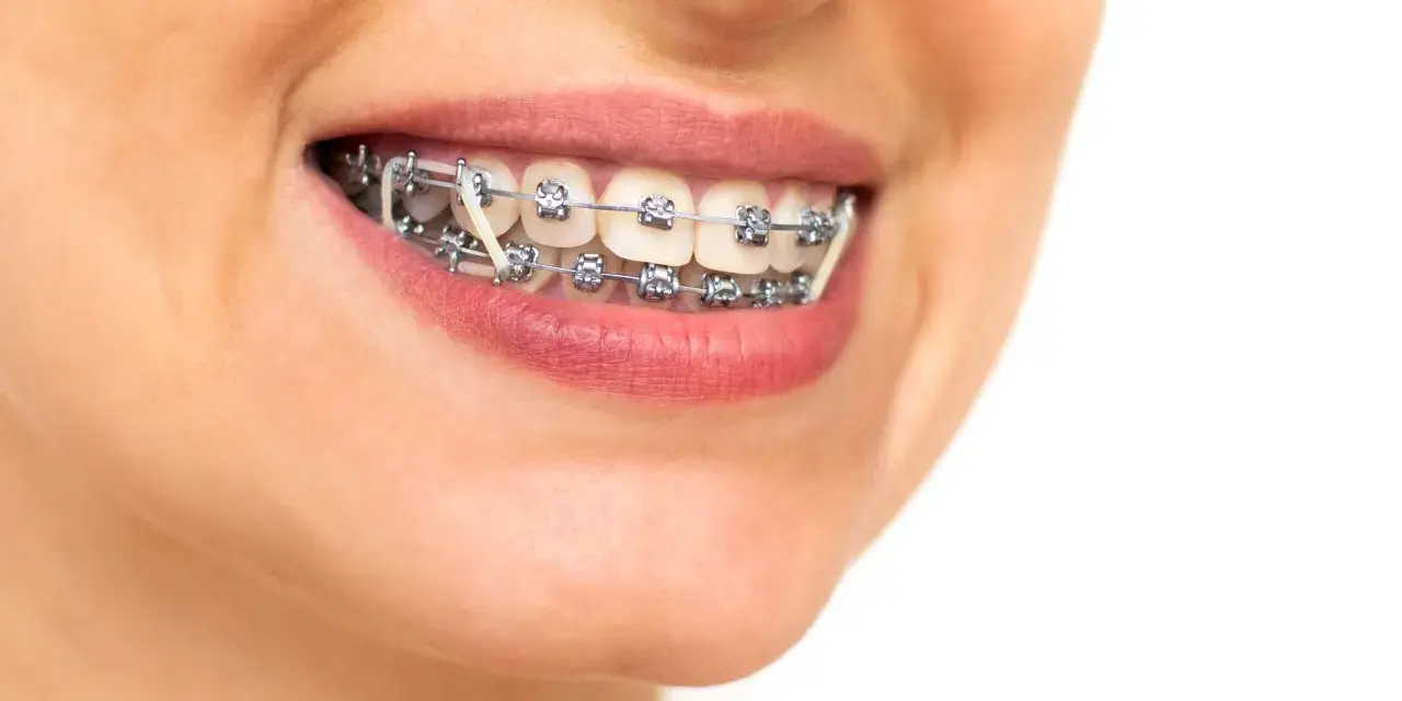 Sorriso con apparecchio ortodontico e elastici intermascellari, per un allineamento perfetto dei denti.