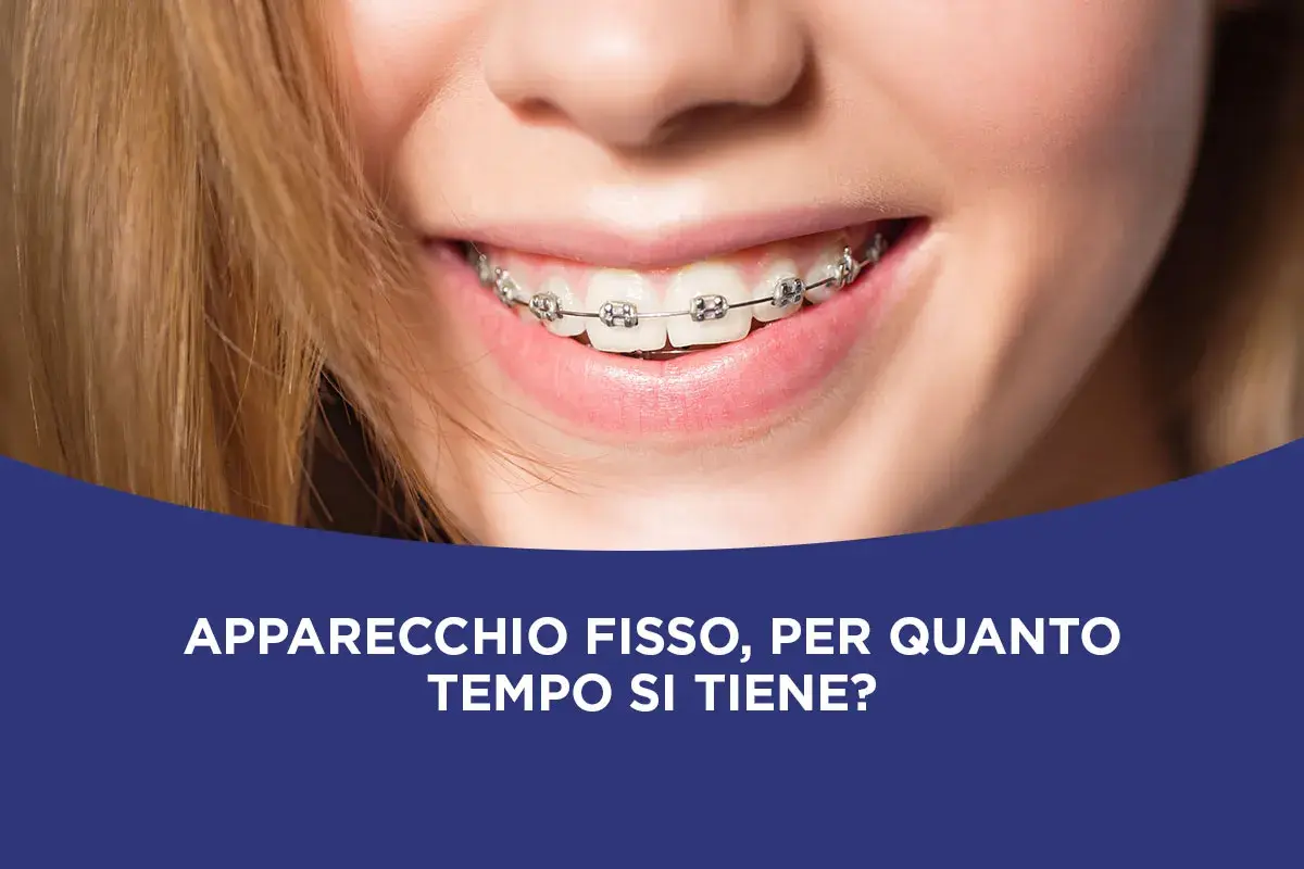 Sorriso di una ragazza con apparecchio fisso. Scopri quanto tempo ci vuole per mettere l'apparecchio e per quanto tempo si tiene.