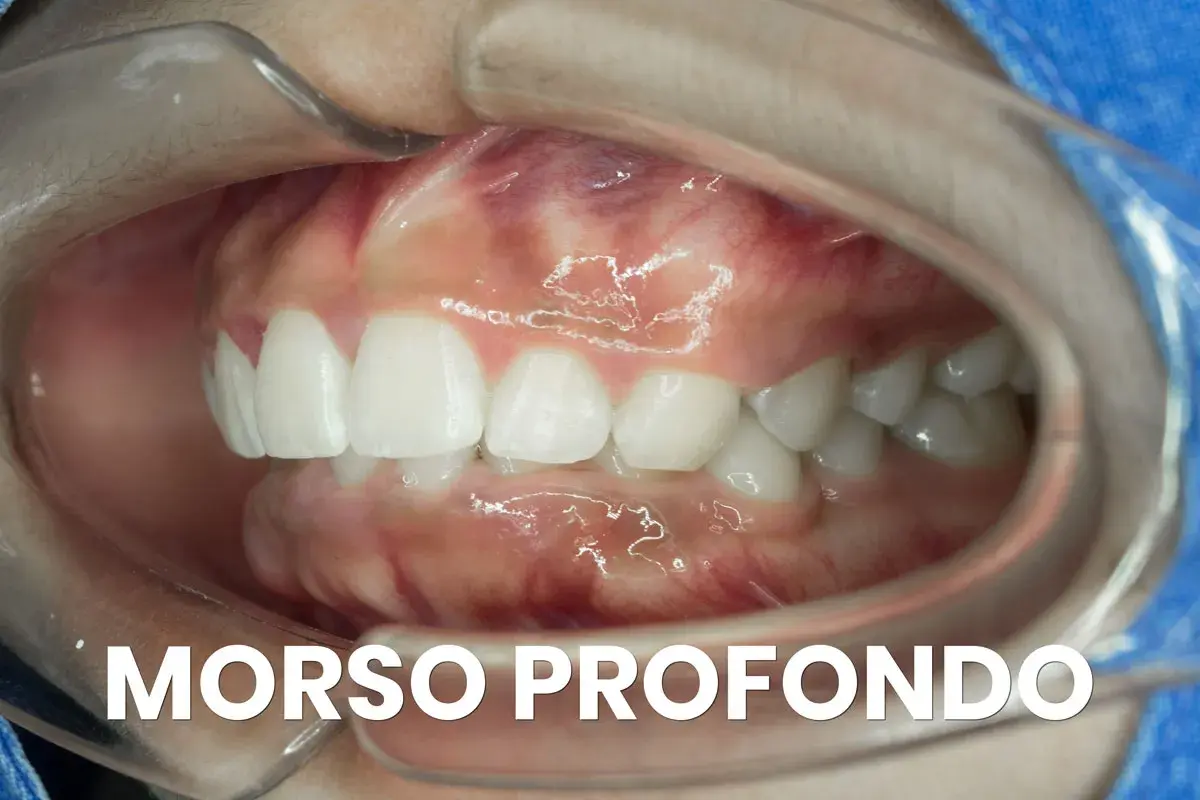 Primo piano della bocca con morso profondo, evidenziato per chirurgia maxillo-facciale.