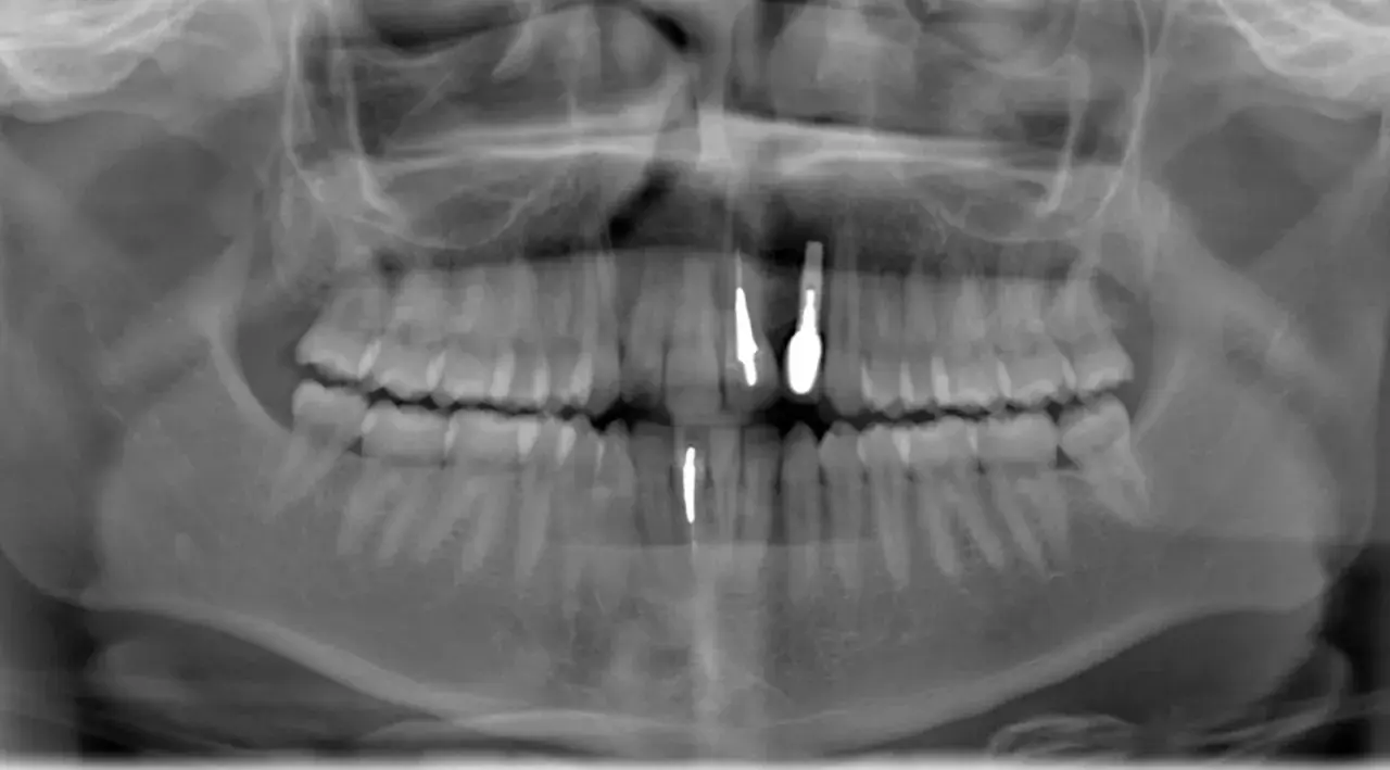 Radiografia panoramica dentale che mostra la sinfisi mandibolare con impianti dentali nella mascella e nella mandibola.