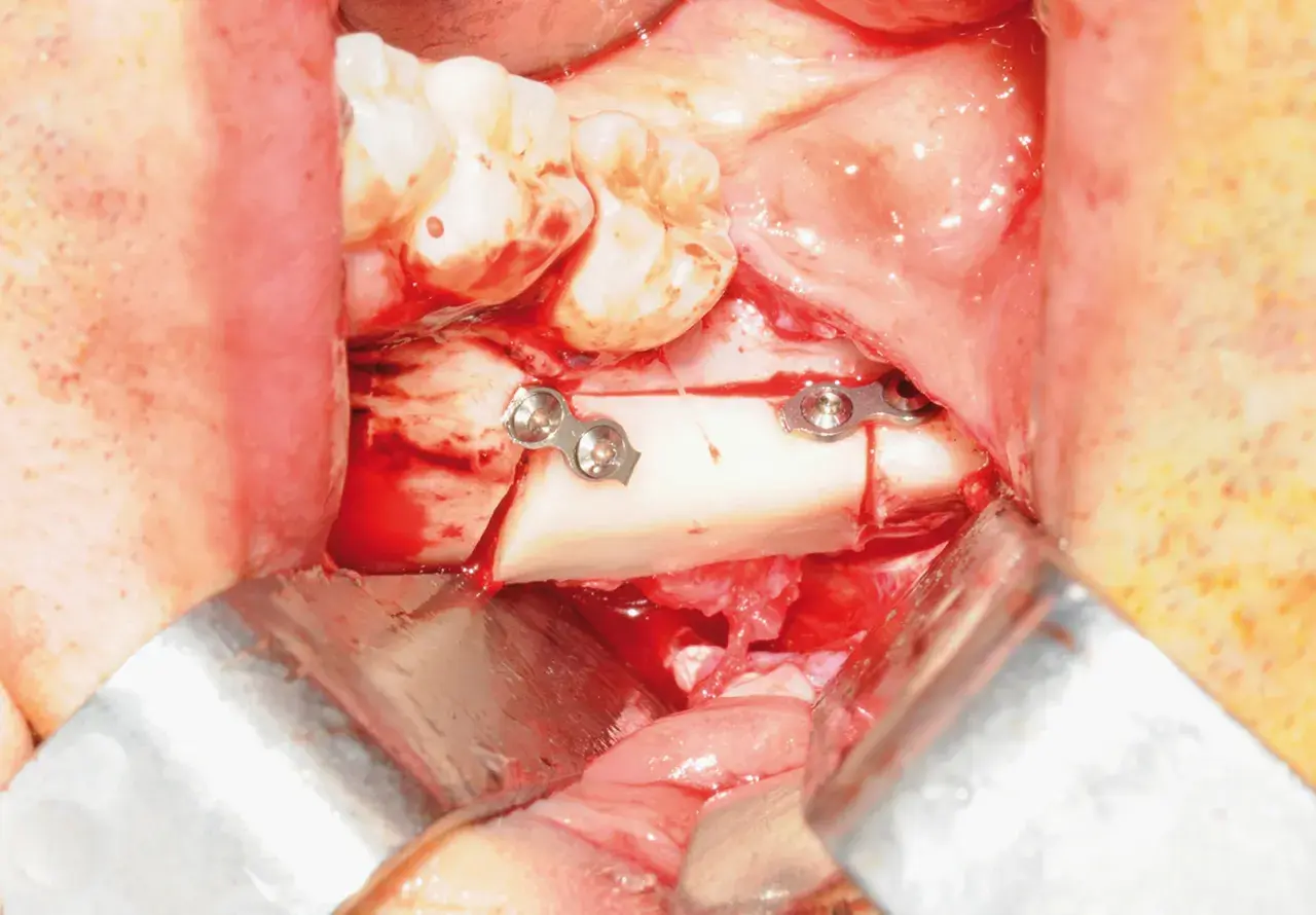 Chirurgia orale: frammento osseo fissato con placche metalliche, vicino al nervo alveolare.