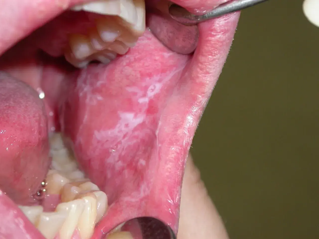 Bocca con leucoplachia, macchie bianche sulla mucosa interna. La buona notizia è che la leucoplachia si guarisce con le giuste cure.
