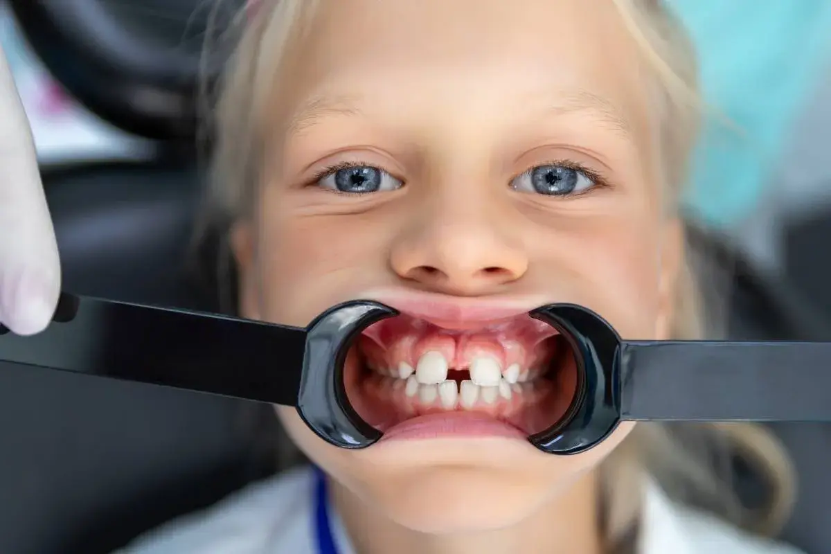 Bambina con diastema, in attesa di apparecchio ortodontico, sorride dal dentista.