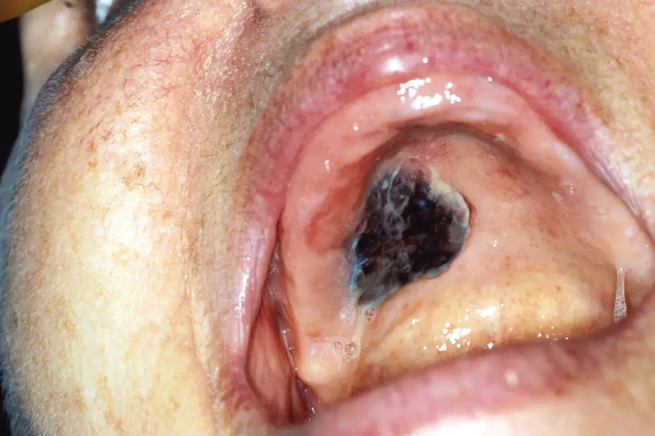 Lesione scura e irregolare sul palato, sospetto melanoma orale.