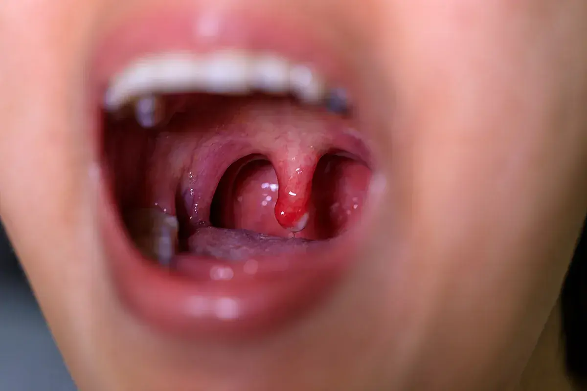 Bocca aperta mostra tonsille arrossate e infiammate, sintomo di mucosite da chemioterapia. Si cercano rimedi naturali.