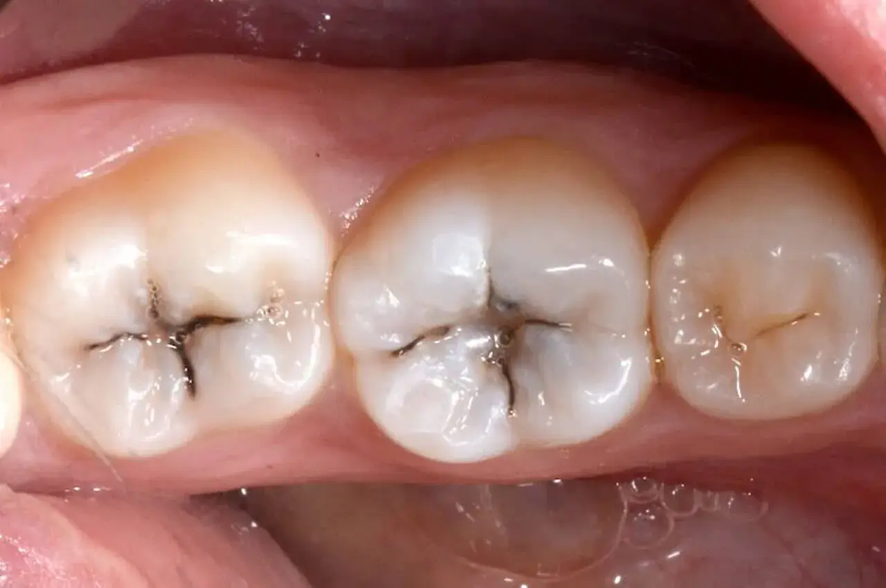 Denti con evidenti segni di carie, con aree scure e profonde che indicano un dente cariato.