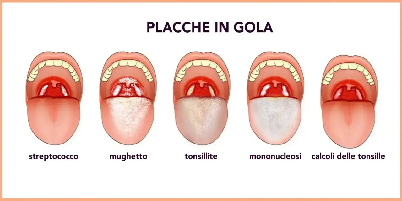 Illustrazione di diverse condizioni della gola, tra cui placche, mughetto e tonsillite, utili per comprendere i rimedi naturali per le placche in gola.