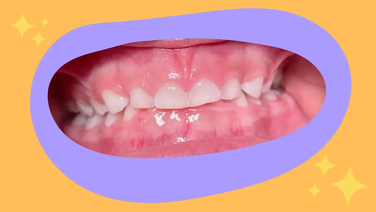 Primo piano dei denti di un bambino con un morso aperto, mostrando gli incisivi superiori e inferiori separati.