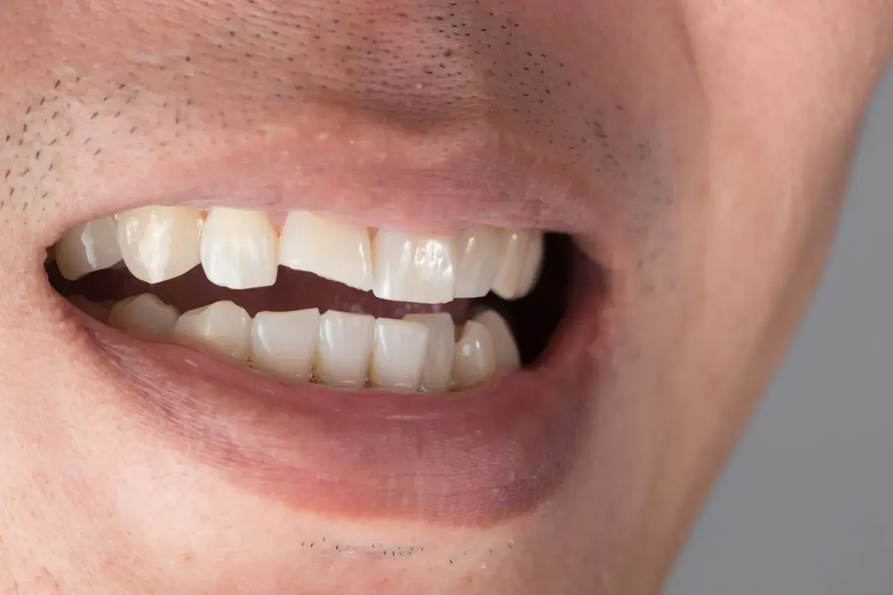 Primo piano di una bocca con un dente bucato lateralmente, mostrando un'evidente carie.