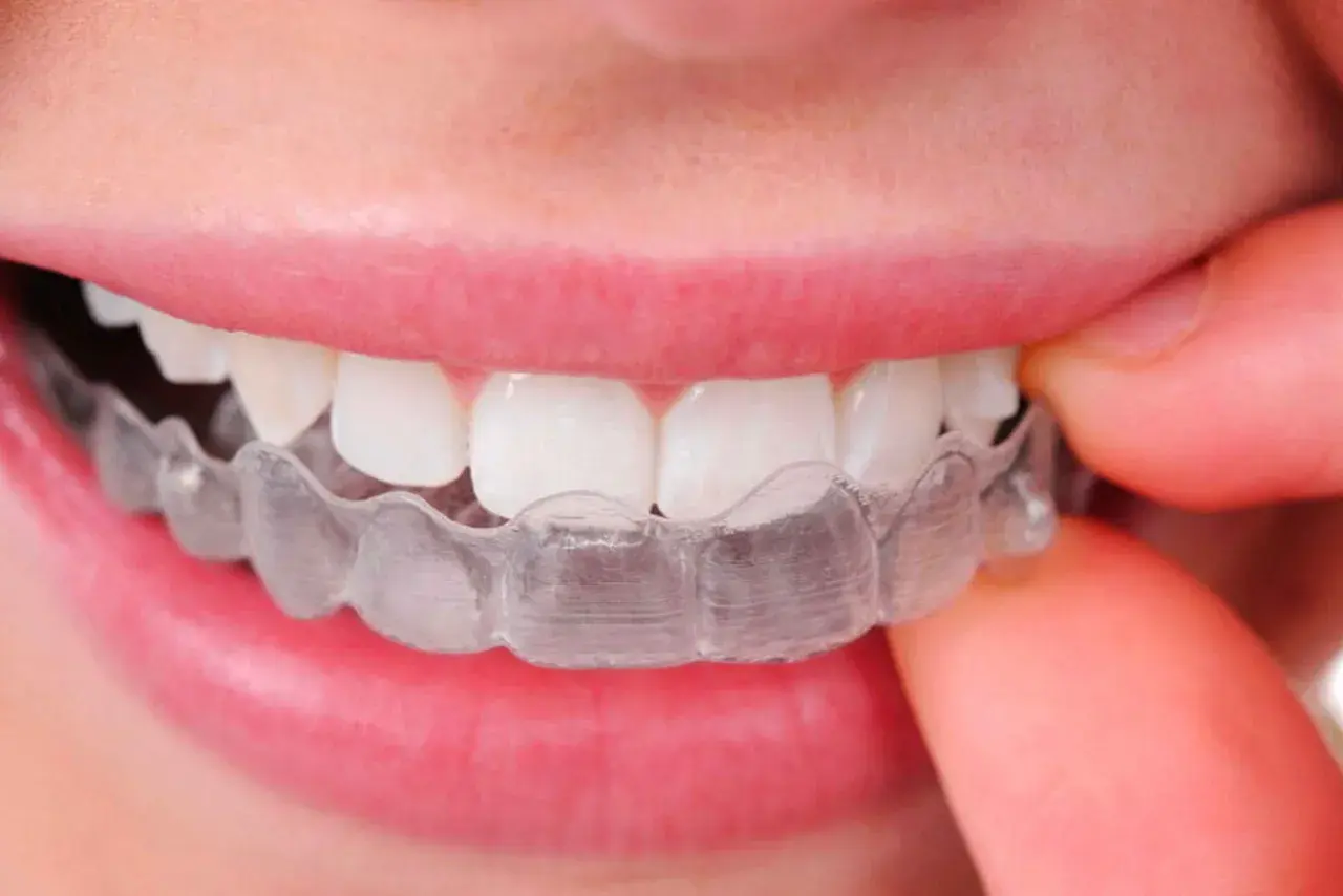 Denti allineati con Invisalign, una scelta discreta anche in gravidanza per un sorriso perfetto.