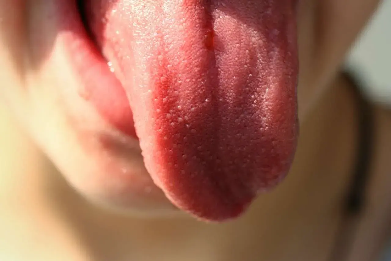 Lingua con papille gustative ipertrofiche, che appaiono come piccoli puntini rossi sulla superficie.