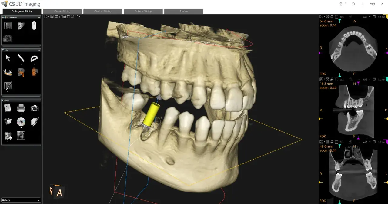 Visualizzazione 3D di un impianto dentale tramite cbct dentale. Sezioni assiali, coronali e sagittali mostrano dettagli ossei e dentali.