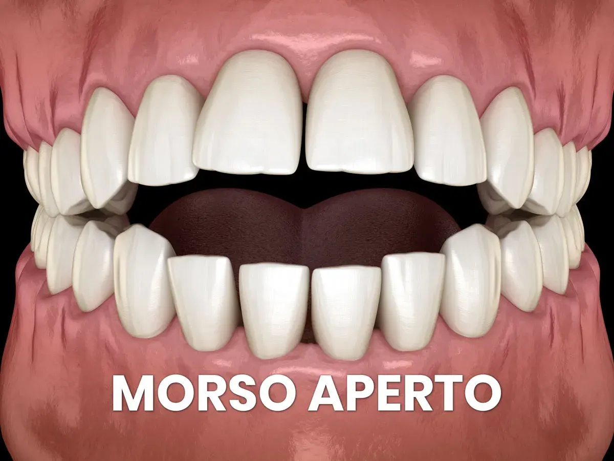 Denti bianchi e gengive rosa mostrano un morso aperto, con uno spazio evidente tra gli incisivi superiori e inferiori.