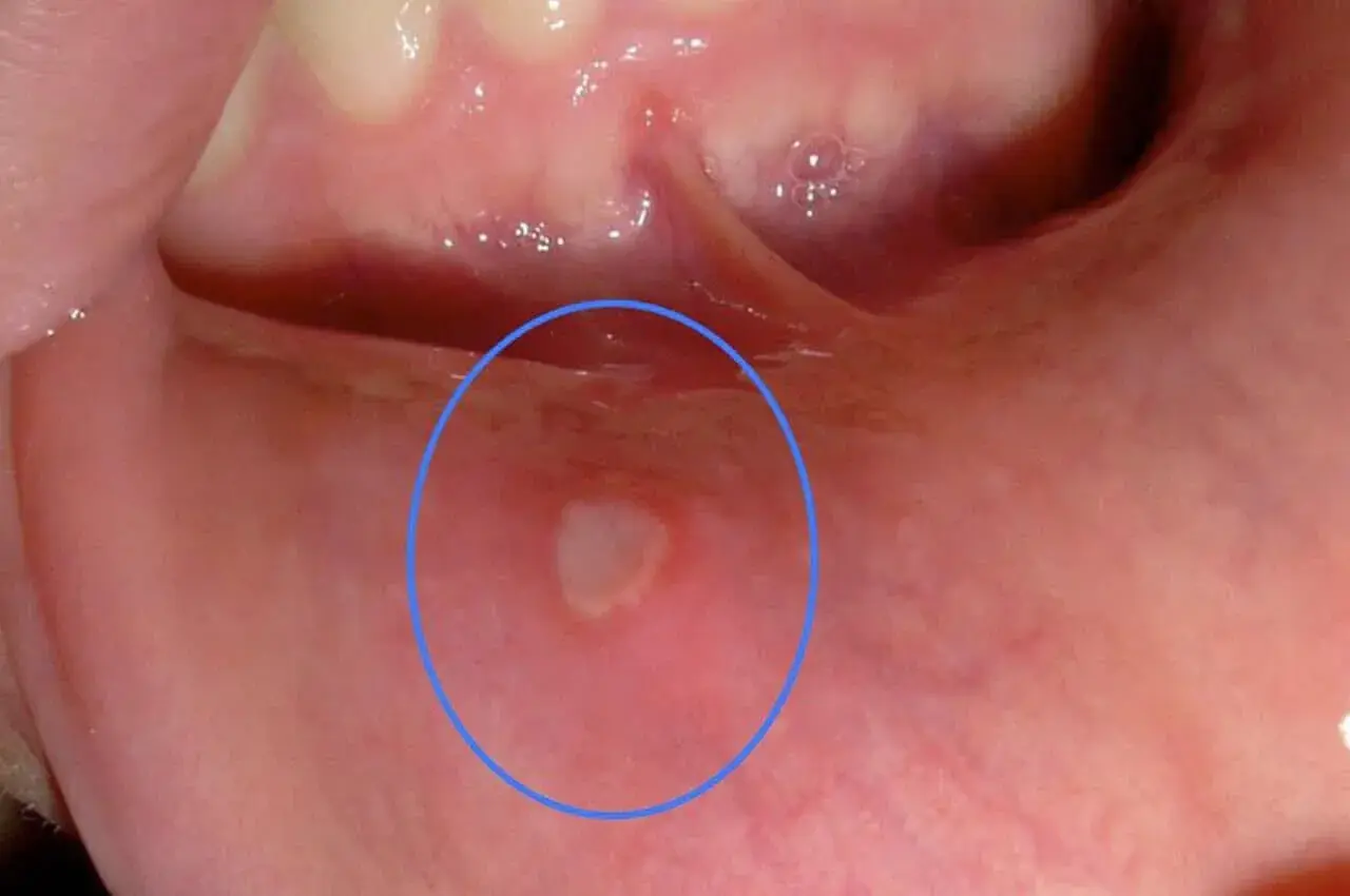 Una piccola afte con filamenti bianchi in bocca, evidenziata da un cerchio blu, appare sulla mucosa interna della guancia.