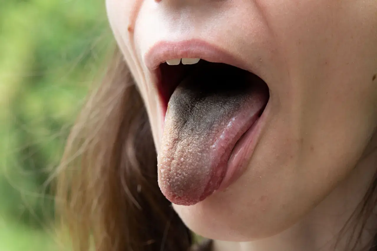 Lingua scura e ruvida, con piccole protuberanze, che suggerisce dolore alla lingua e alla gola.