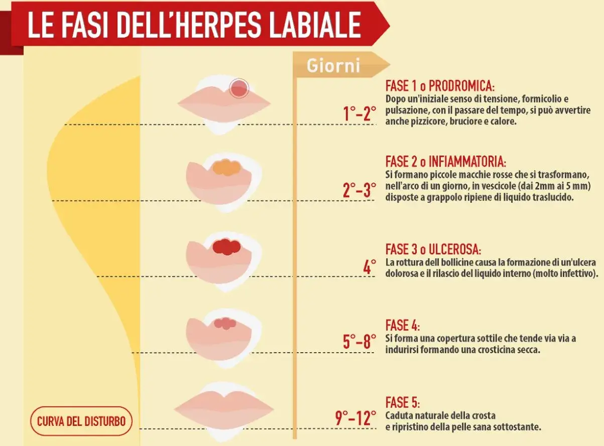 Le fasi dell'herpes labiale: dalla fase prodromica (1-2 giorni) all'ulcera e alla guarigione (fino a 12 giorni).