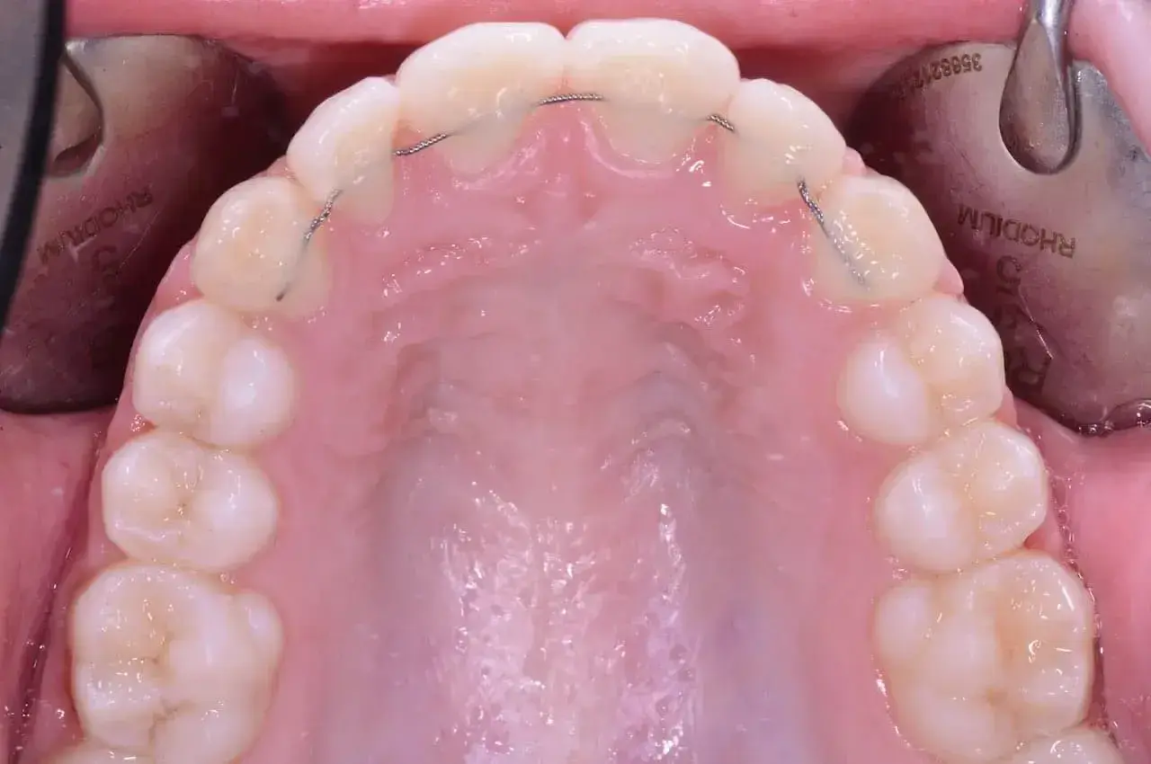 Denti dopo apparecchio con filo metallico di ritenzione. Un sorriso perfetto è il risultato di cure attente.