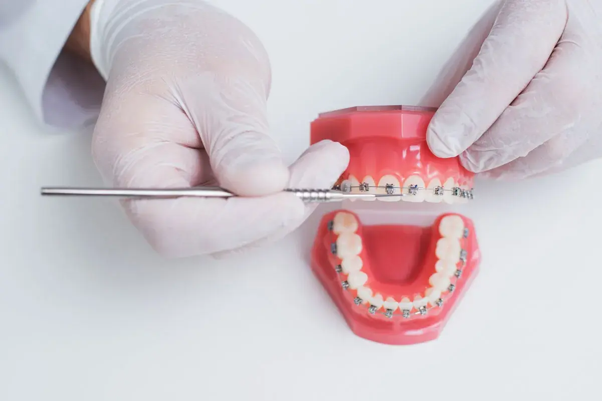 Modello di denti con apparecchio, per correggere denti storti adulti.