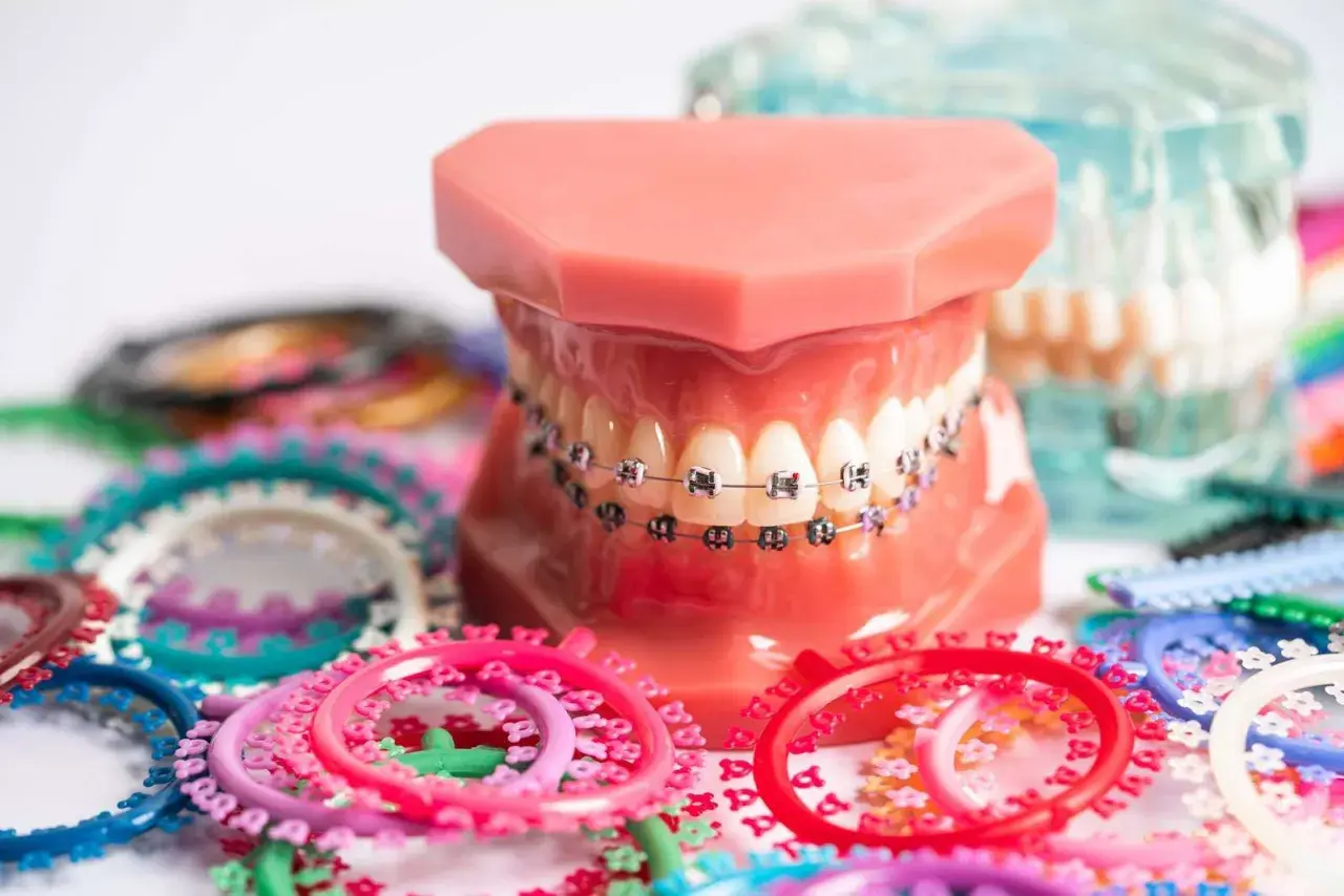 Modello di denti con apparecchio ortodontico, che ricorda l'apparecchio denti anni 80, circondato da elastici colorati.
