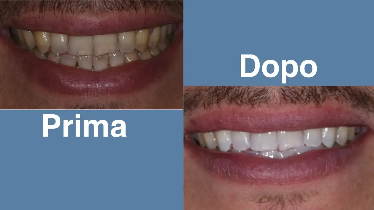 Prima: denti ingialliti con apparecchio fisso trasparente. Dopo: sorriso smagliante con denti bianchi e perfetti.