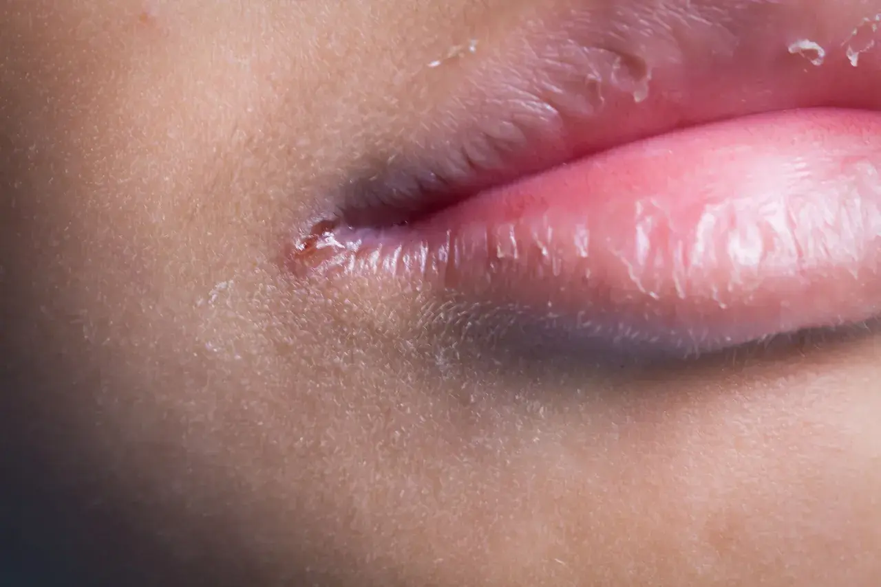 Close-up di labbra con pelle secca e screpolata, e una piccola lesione. Si nota una lieve leucoplachia labbra.