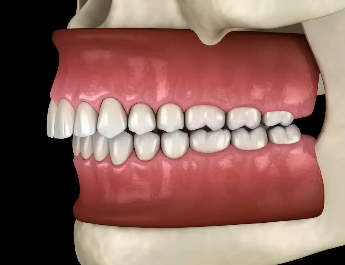 Vista laterale di denti con malocclusione dentale, i denti superiori sporgono notevolmente su quelli inferiori, un sintomo comune.
