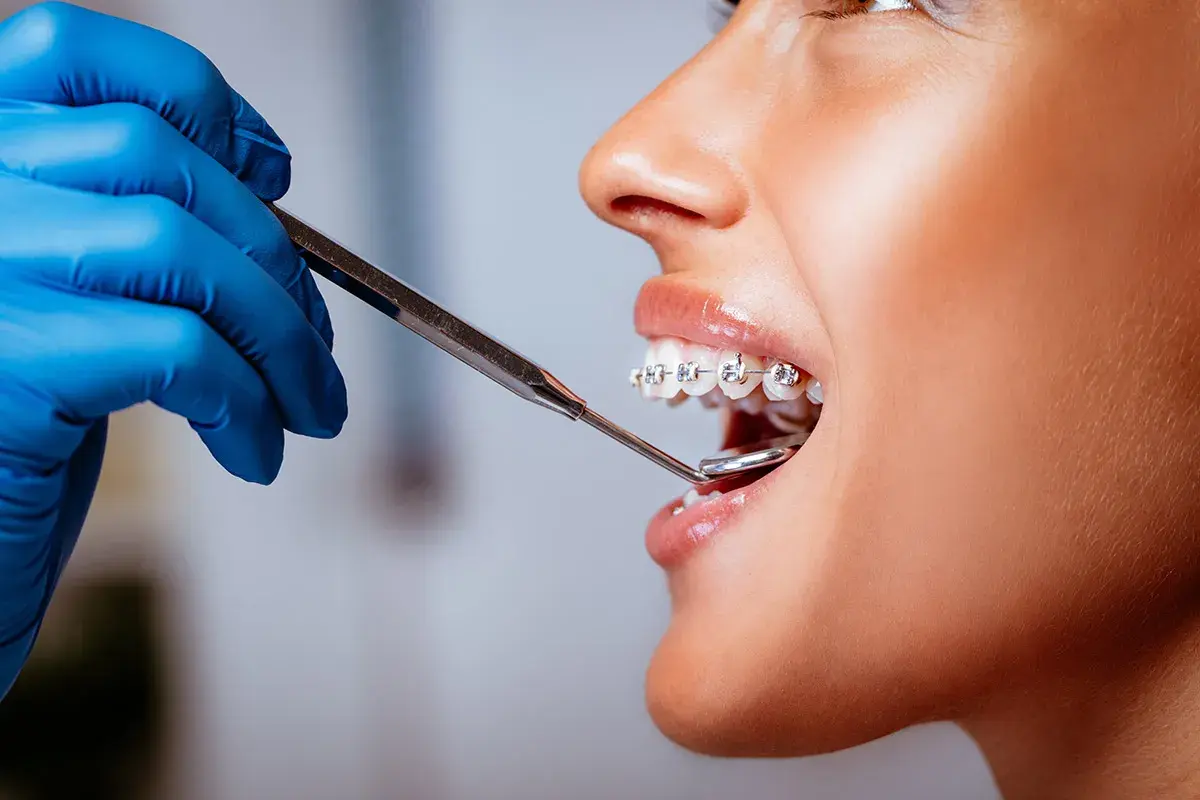 Primo piano di una bocca con apparecchio, mentre un dentista con guanto blu esamina i denti per raddrizzare i denti.