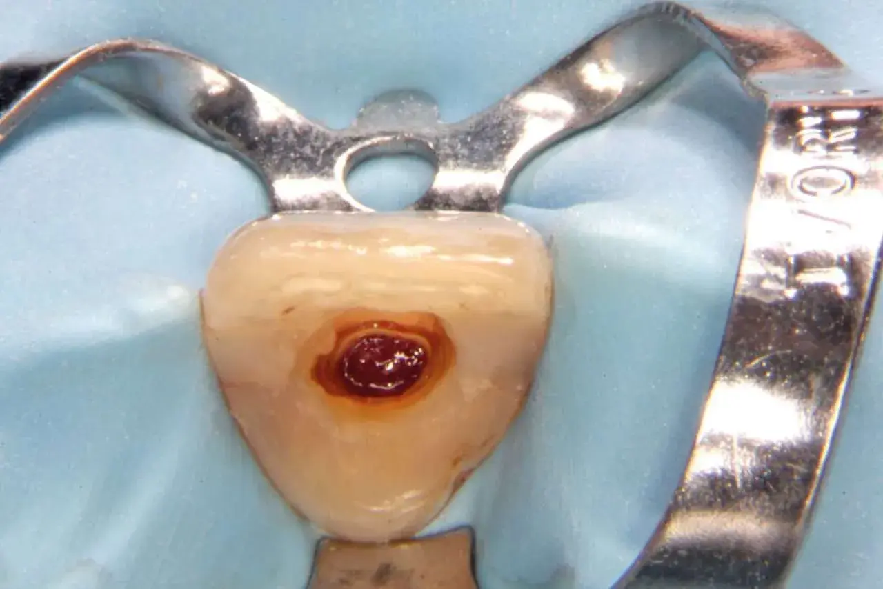 Dettaglio di un dente con cavità preparata per il cemento radicolare, isolato con diga di gomma e clamp metallico.