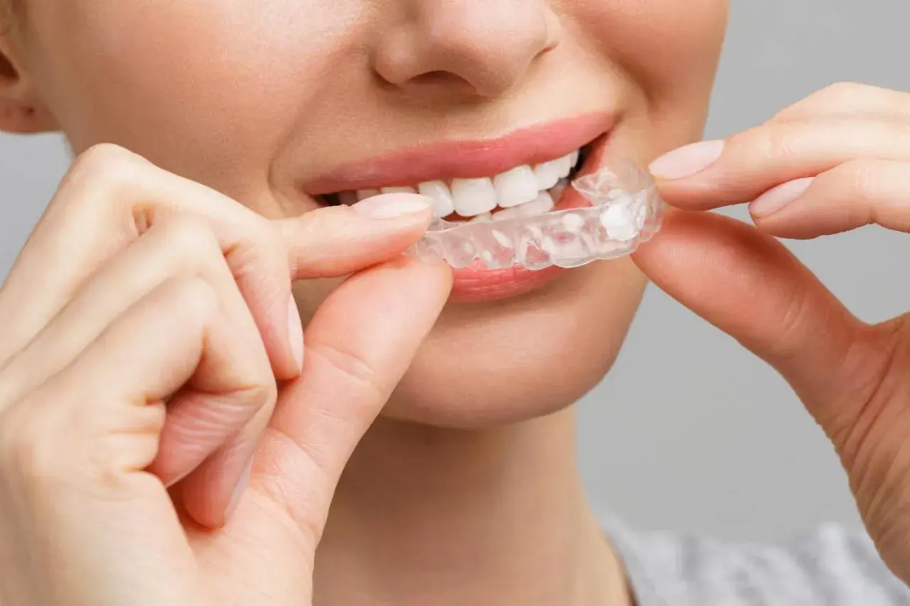 Sorriso smagliante con mascherine denti prima e dopo. La trasparenza delle mascherine invisibili per un sorriso perfetto.
