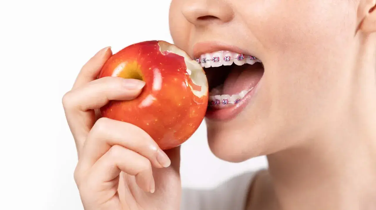 Mentre si morde una mela rossa, si vedono i denti con l'apparecchio. Un esempio di cosa mangiare con l'apparecchio, con cautela.