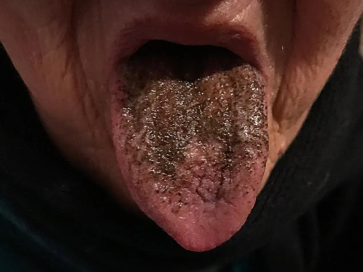 Lingua marrone, forse per cause legate all'alimentazione o a farmaci, appare ricoperta da una patina scura e granulosa.