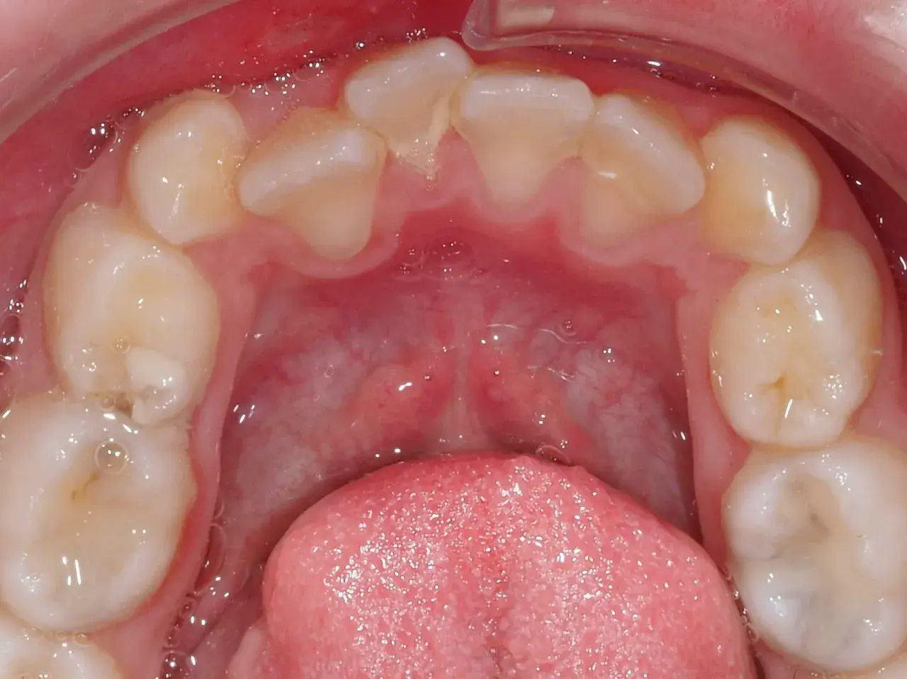 Vista ravvicinata dell'arcata dentale inferiore con evidente affollamento dentale inferiore. Si notano denti leggermente storti e sovrapposti.