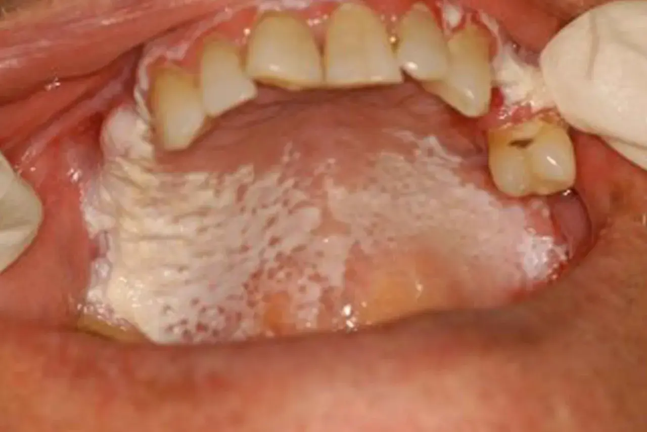 Leucoplachia palato: placche biancastre e irregolari sul palato, con aree rosse e puntini.