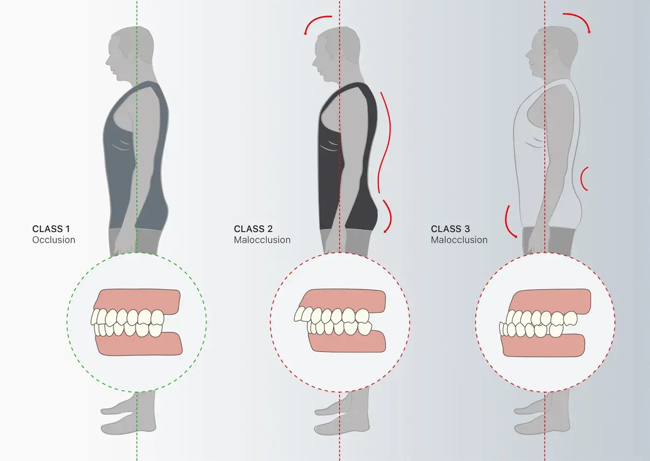Illustrazione della classificazione di angle: Class 1 (occlusione corretta), Class 2 e Class 3 (malocclusioni) con dettagli dentali.