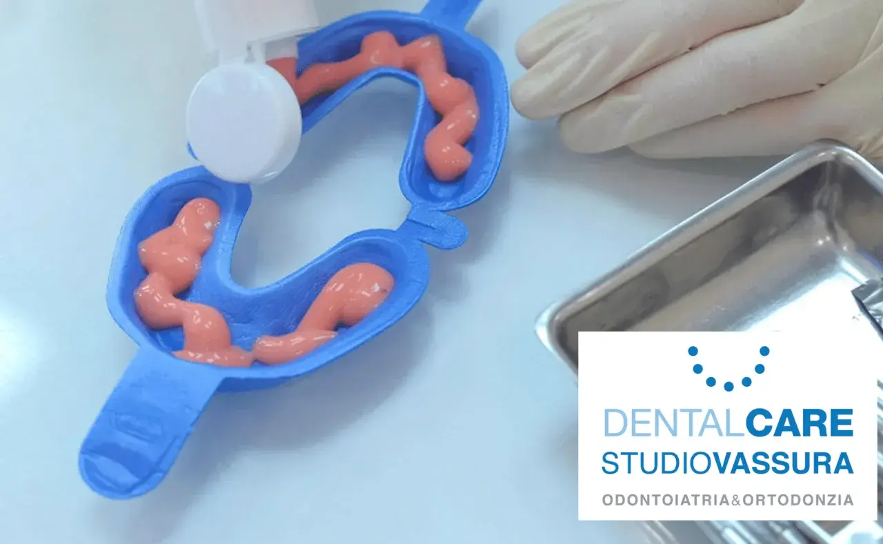 Applicazione di gel per fluoro profilassi in un portaimpronte dentale.