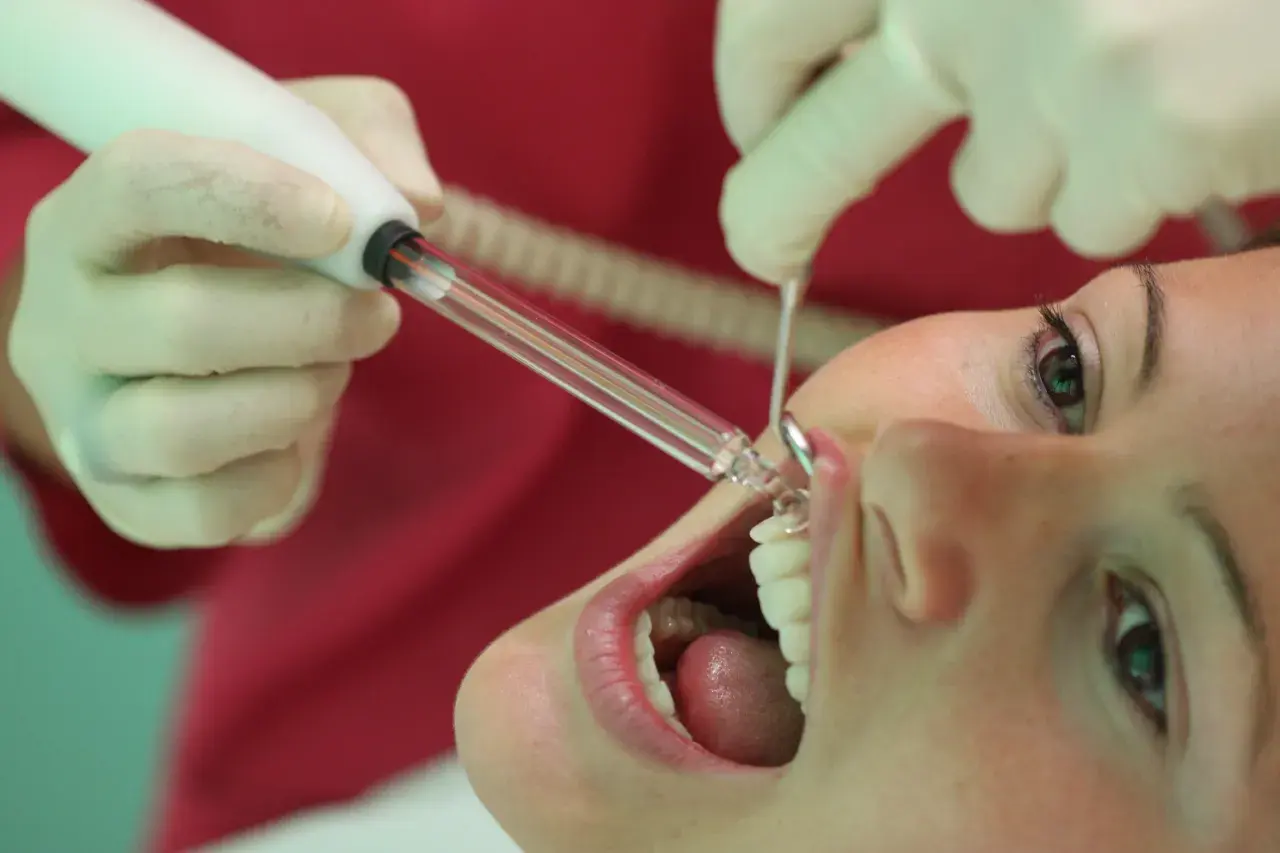 Trattamento dentale con ozono. Un dentista usa uno strumento per applicare il gel ozono sui denti di una paziente.