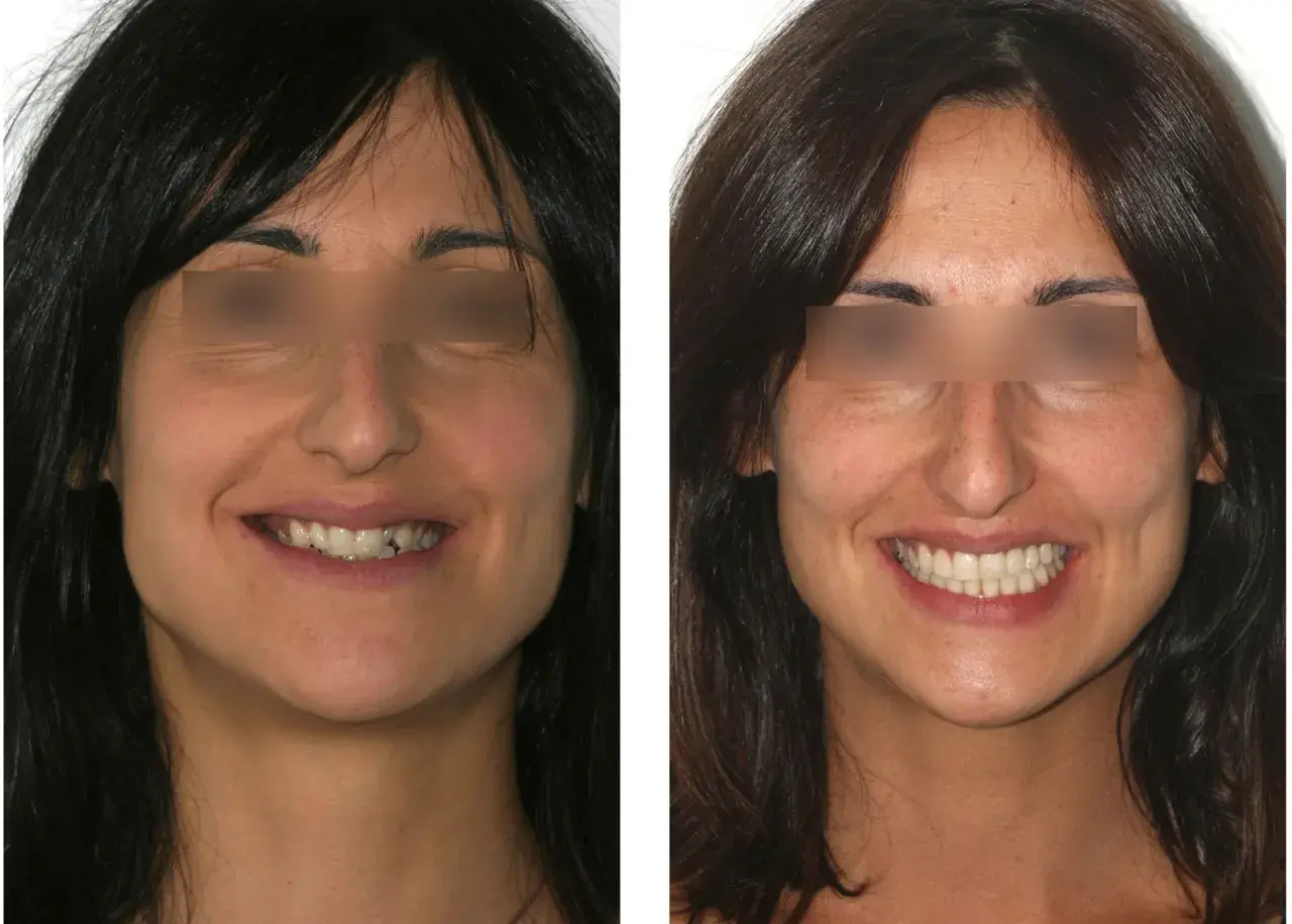 Sorriso prima e dopo: miglioramento estetico del canino incluso e dei denti.