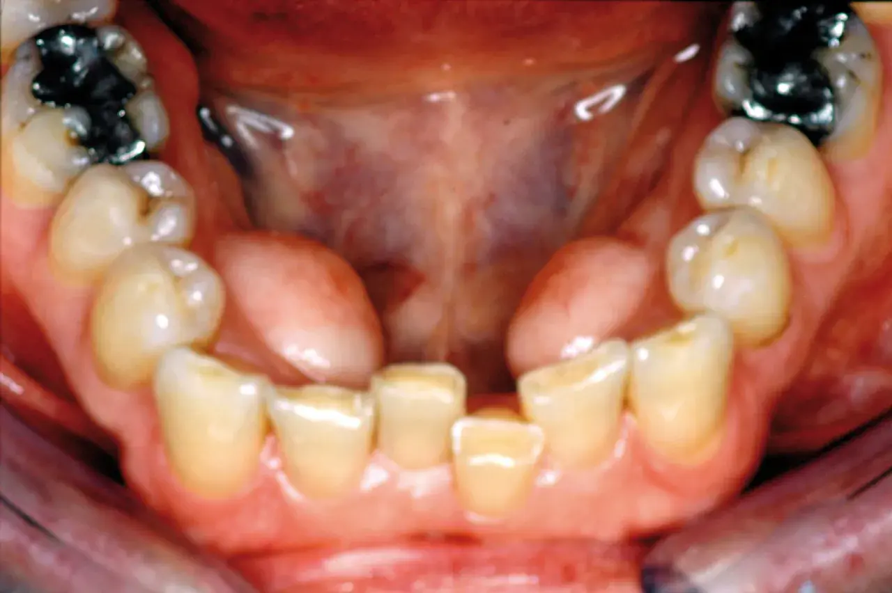 Vista ravvicinata della bocca con denti inferiori e superiori visibili. Si nota una piccola protuberanza carnosa, forse un'esostosi, sulla gengiva.