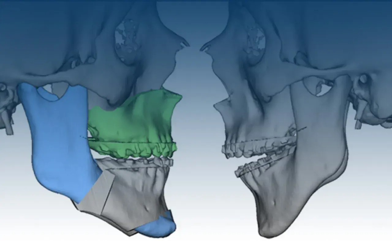 Modellazione 3D di un intervento maxillo-facciale per correggere una terza classe, evidenziando le aree di osteotomia e i potenziali rischi.