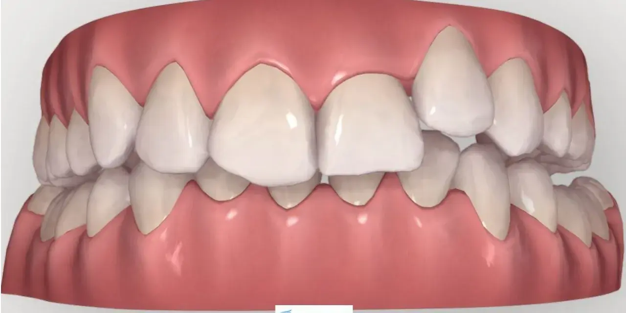 Arcata dentale con un dente storto in evidenza, che necessita di correzione ortodontica per un sorriso perfetto.