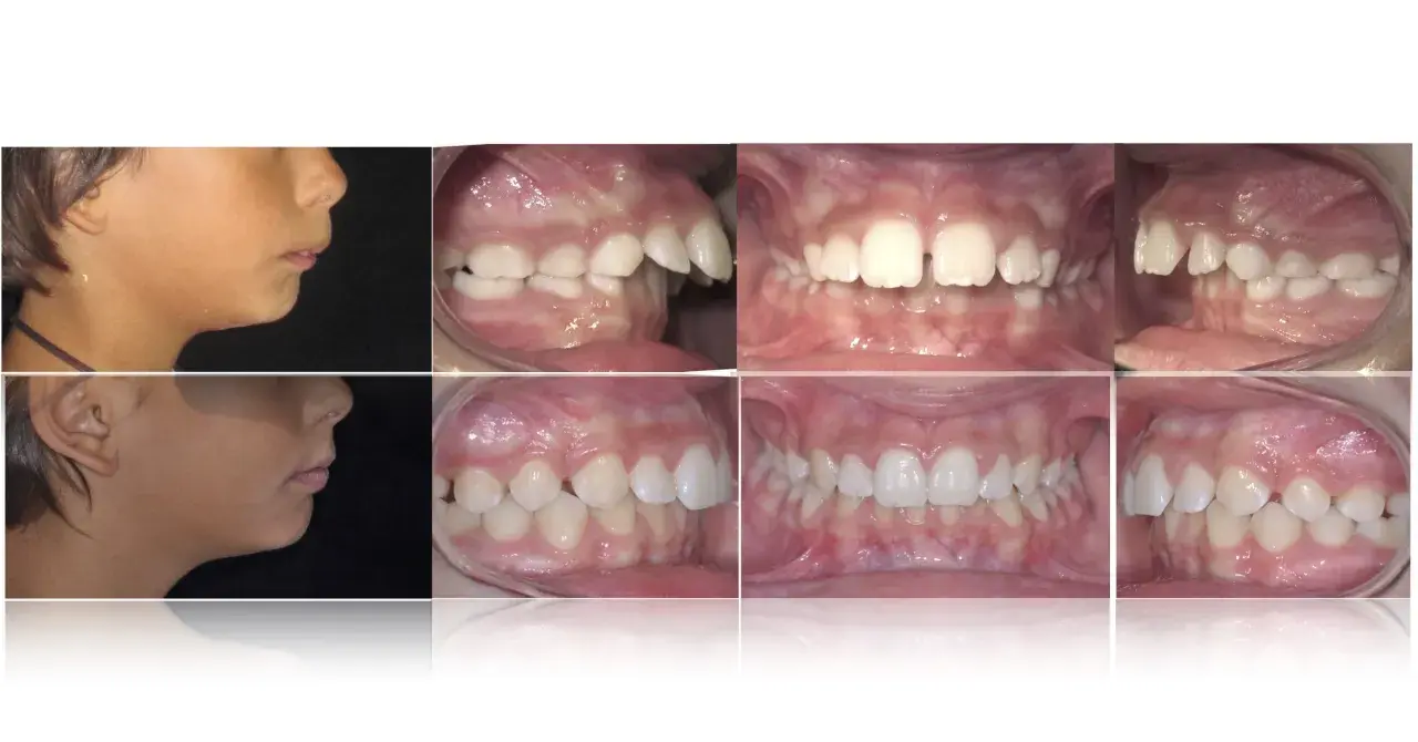 Prima e dopo: correzione di denti a castoro e malocclusioni.
