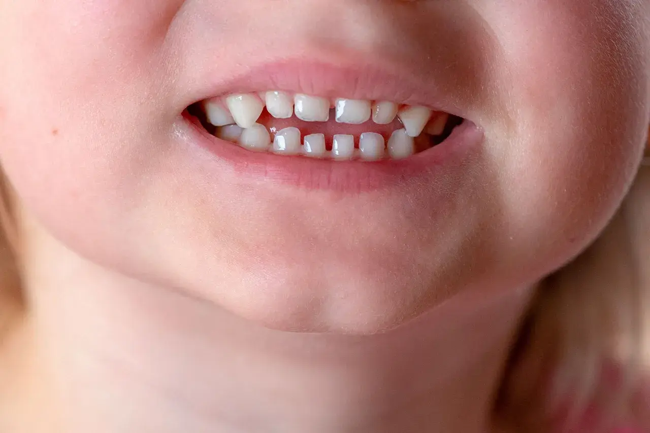 Primo piano di un sorriso di bambino con un diastema tra i denti inferiori, che mostra i denti da latte.