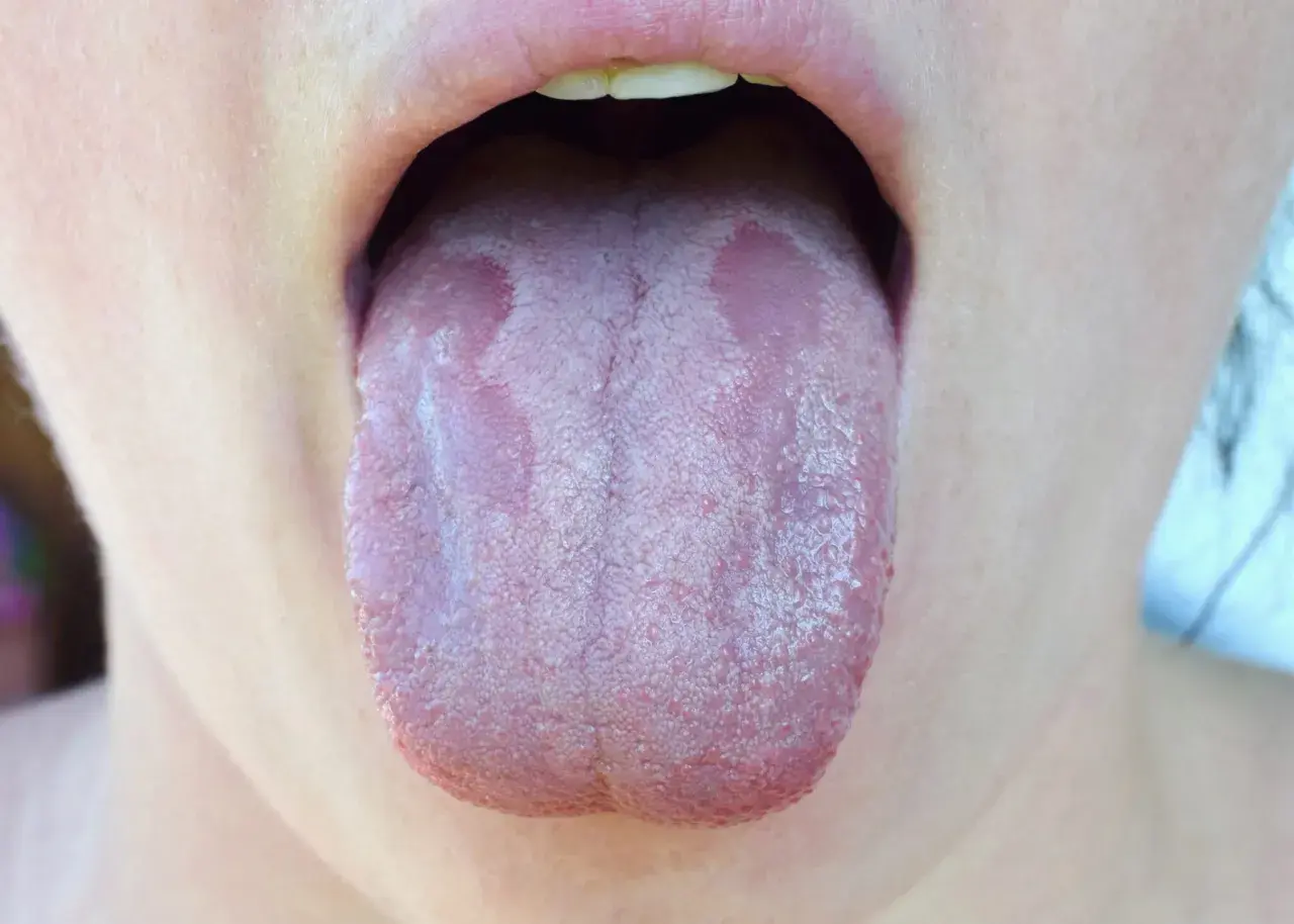 Lingua con placche biancastre, sintomo di candida orale. Si valuta l'uso di fermenti lattici per candida orale.
