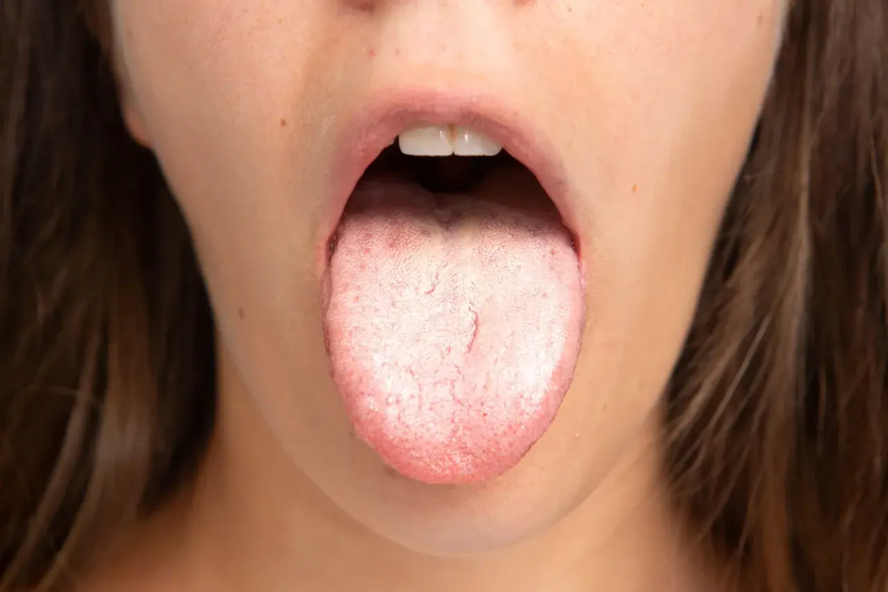 Lingua con patina biancastra e rossore, possibile sintomo di candida orale da stress.