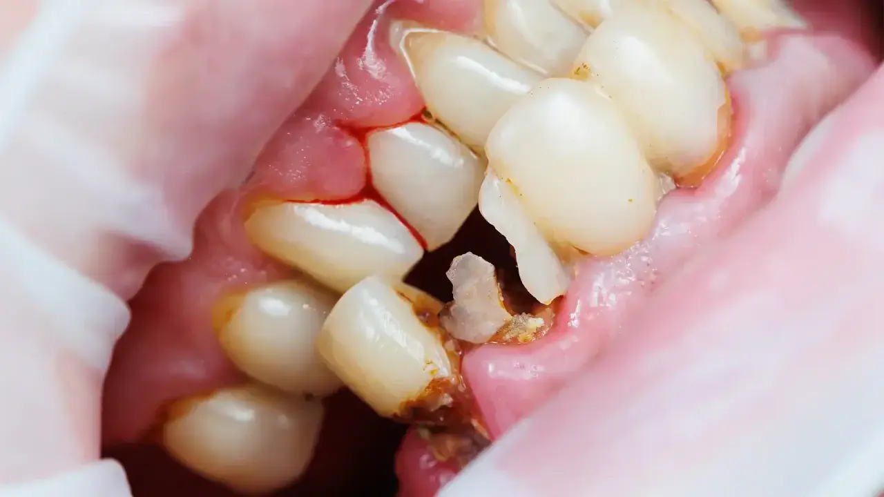 Denti con evidenti crepe e carie, gengive infiammate e sanguinanti. Un quadro preoccupante di salute orale.