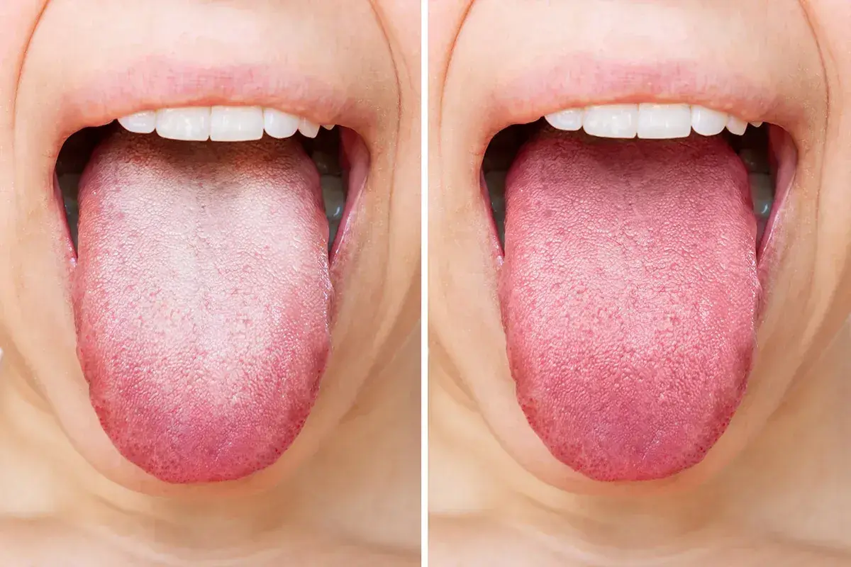 Confronto tra una lingua bianca e una lingua sana e rosa. La lingua gialla può indicare problemi di igiene o salute.