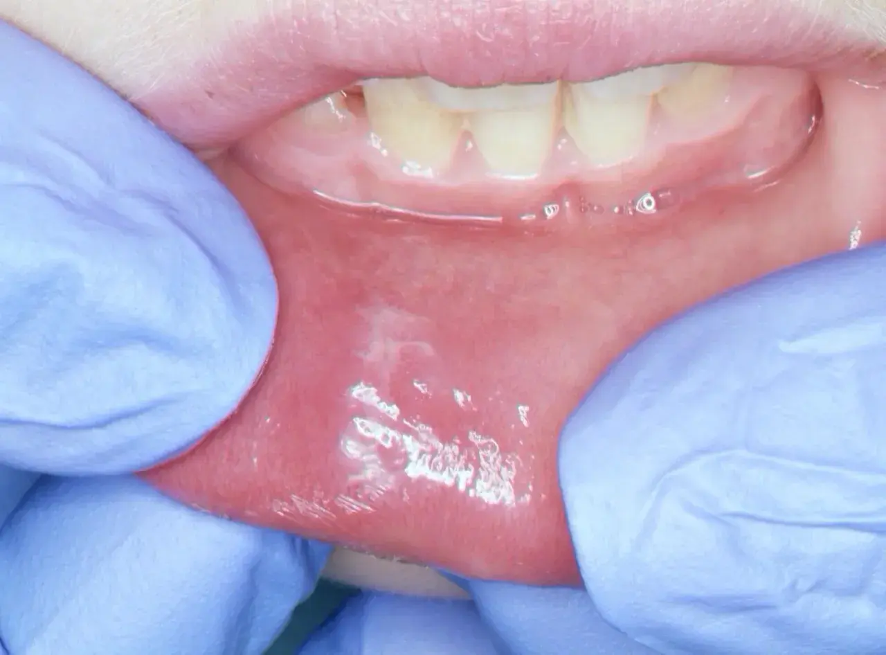 Dita guantate espongono la mucosa orale, rivelando una macchia bianca sul labbro inferiore, forse un segno di irritazione.